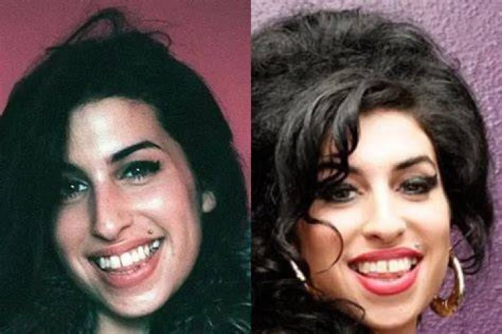 Amy Winehouse gets teeth fixed, some advice from Keith Richards