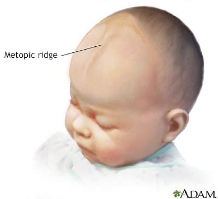 Does benign Metopic Ridge go away?