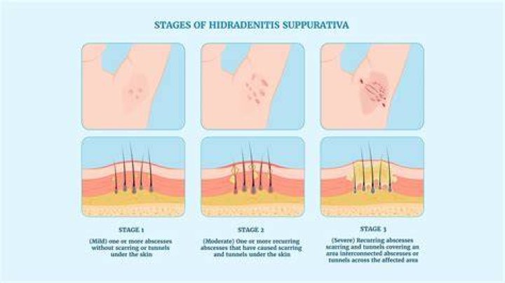 Does hidradenitis suppurativa itch?