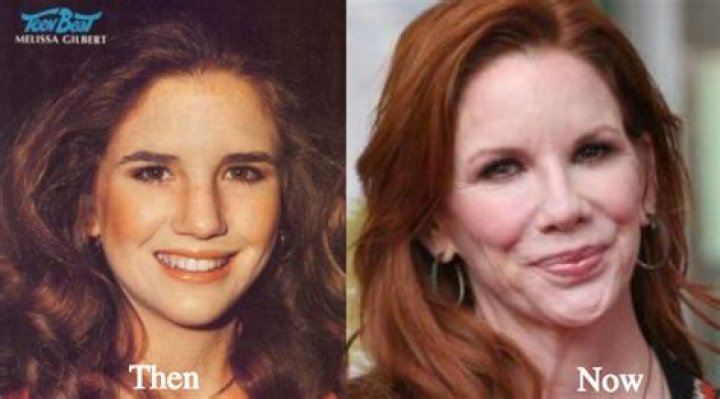 Melissa Gilbert’s plastic surgery: too noticeable?