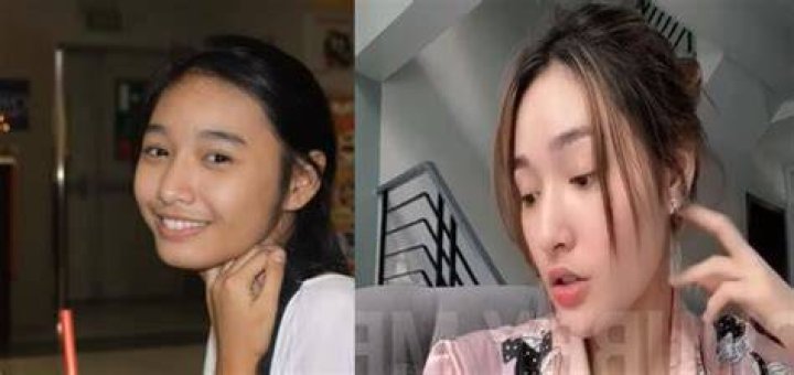 Sachzna Before Surgery