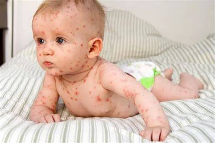 Source: WebMD (Chickenpox rashes)
