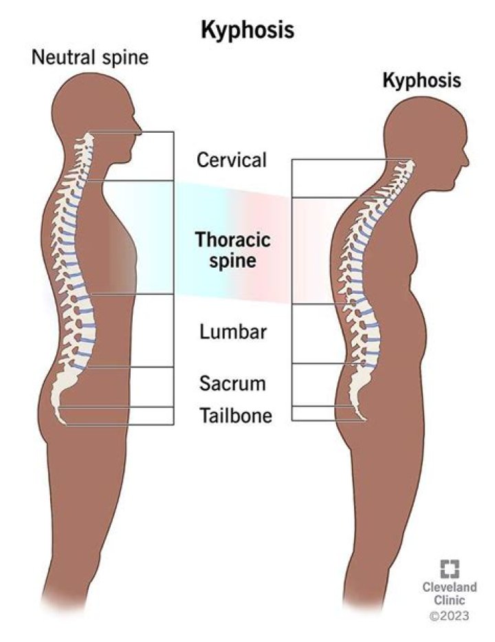 What anatomic location does kyphosis refer to?