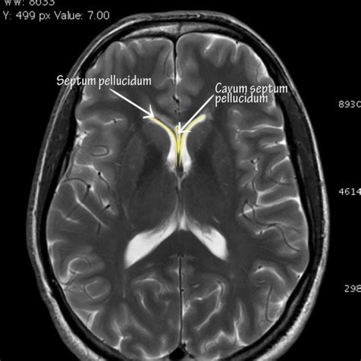 What does the septum pellucidum do?