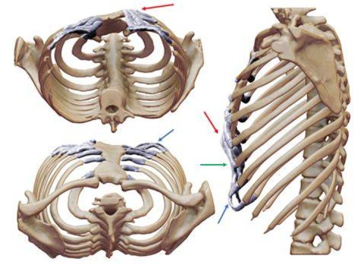 What is a compressed rib?