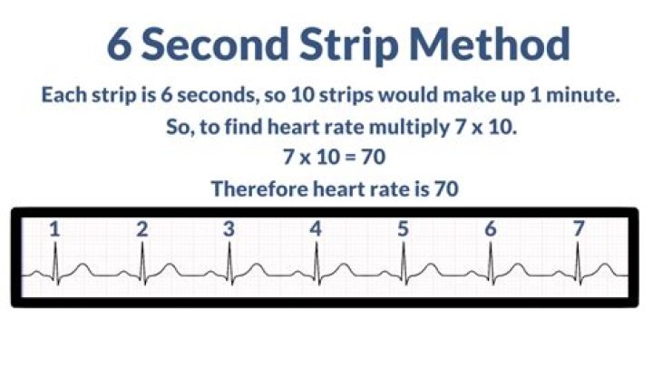 What is a six second strip on ECG?