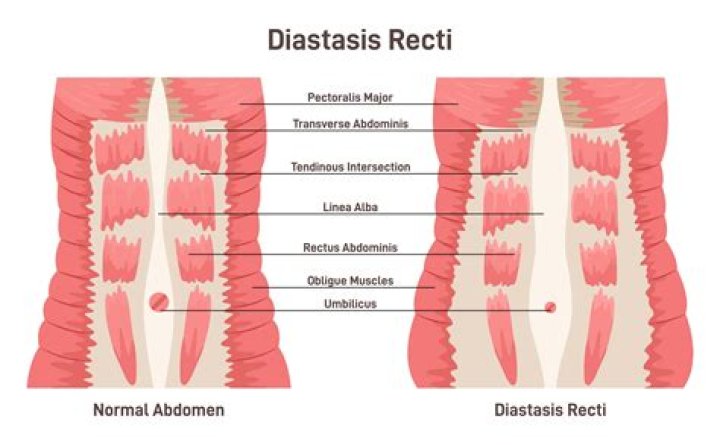 What is the ICD 10 code for rectus Diastasis?